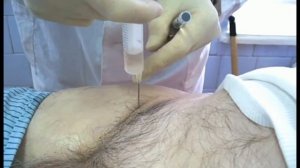 Федоров В.Г. Пункция тазобедренного сустава, введение хондропротектора