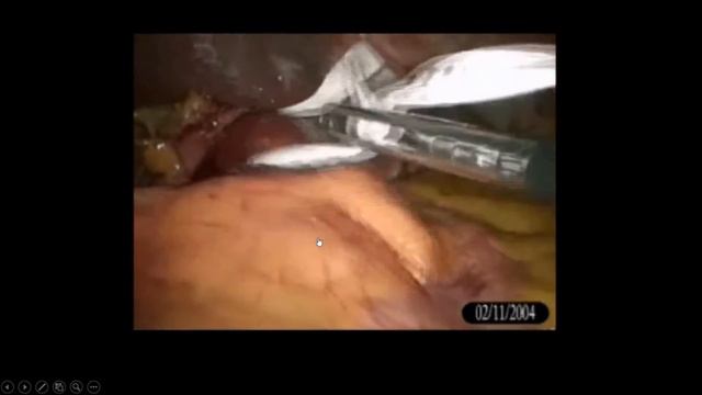 Laparoscopic Fundoplication Lecture By Dr R K Mishra
