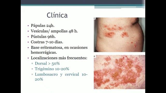 Microbiologia Herpes смотреть онлайн