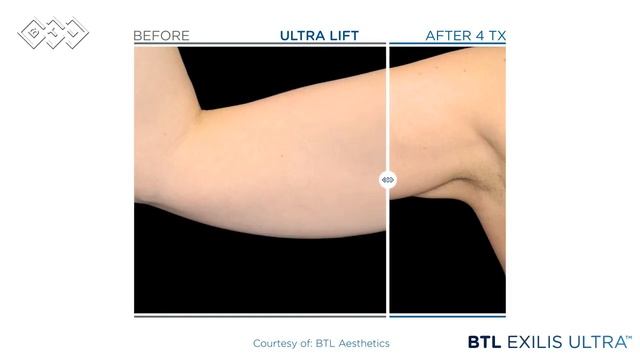 BTL Exilis Ultra Before & After Photos смотреть онлайн