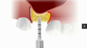 Закрытый синус-лифтинг