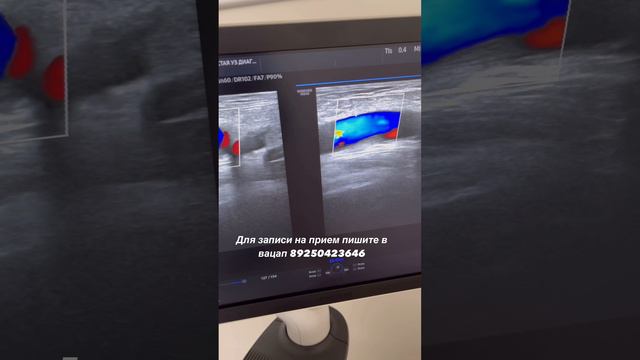 Обследование сосудов. Узи артерий. Высокий холестерин, атеросклероз. Флеболог Москва. Флеболог