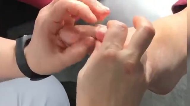 Подолог. Ортоз и корневой мозоль #мозоль #корневой мозоль #ортоз #педикюр #подолог #подологкиев