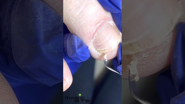 Зачистка в педикюре часть 2 #nail #подология #онихолизис