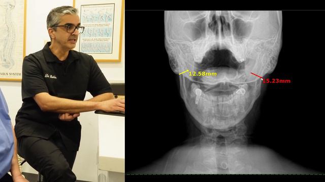 12 Years Of Hip & Leg Pain Helped: Tailbone, Sacrum, & Pelvis Adjustments + TMJ Session By Dr. Rahi