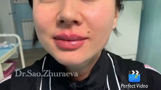 Коррекция губ филером на основе гиалуроновой кислоты
