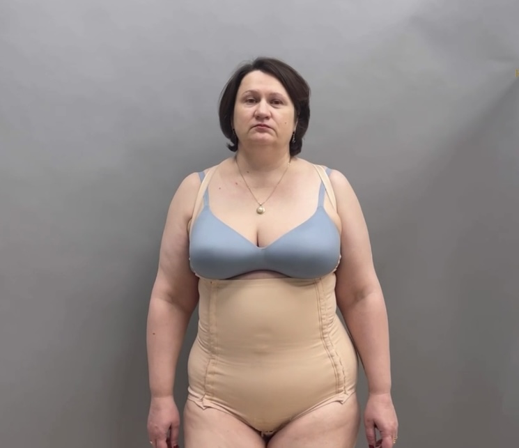 Абдоминопластика с переносом пупка: результат спустя 2 недели. смотреть онлайн