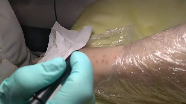 Электроэпиляция на ногах (часть1) смотреть онлайн