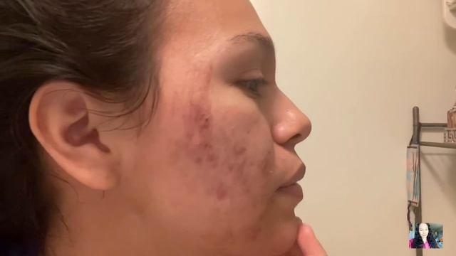 trying tca peel at home for the first time el ácido químico para acné/cicatrices. смотреть онлайн