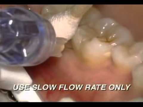 Milestone Modified PDL injection method смотреть онлайн