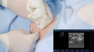 Анестезия плечевого сплетения под ультразвуковой навигацией. Трансляция из операционной 20.10.2023 г