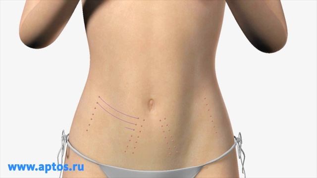 Aptos Exellence Аптос Экселенс New Methods Of Plastic Surgery