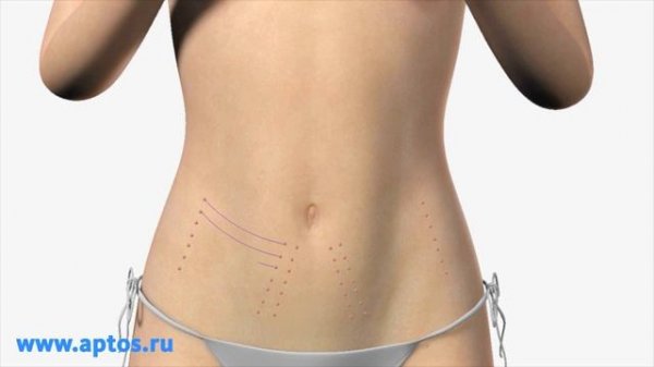 Aptos Exellence Аптос Экселенс new methods of plastic surgery
