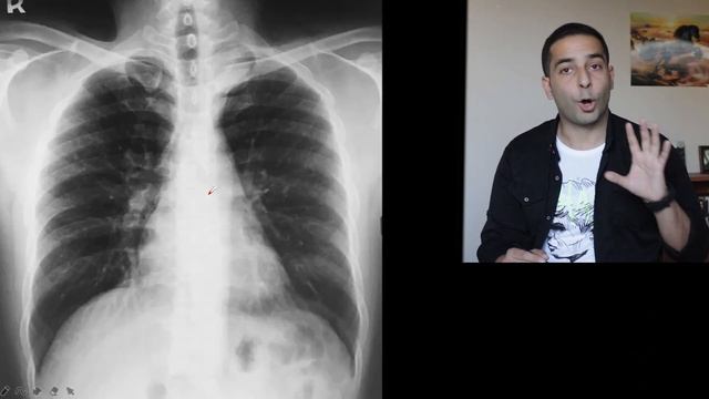 Hidden areas in CXR | DO NOT miss those places in CXR | اهم الأماكن الخفية في صورة الصدر. انتبه لها смотреть онлайн