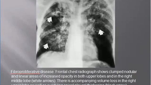 Lecture of Dr. Saqib Ahmad on Topic PUL TB смотреть онлайн