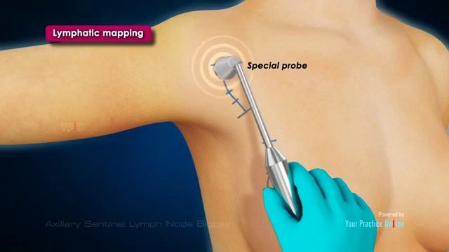 Axillary Sentinel Lymph Node Biopsy. More video? https://dentalapplica.com/ смотреть онлайн
