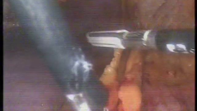UNC_Videos ( Lap. Decortication of Renal Cyst ) By Prof. Ahmed Elshal смотреть онлайн