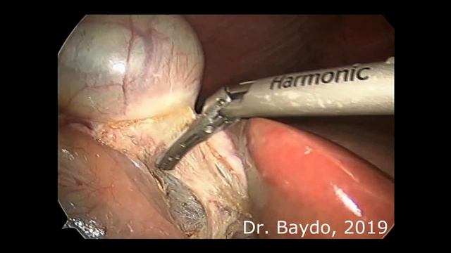 Laparoscopic cholecystectomy смотреть онлайн