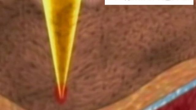 Мезороллеры смотреть онлайн