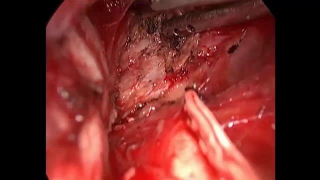 Asvide: Uniportal video-assisted thoracic surgery right mediastinal lymph node dissection... смотреть онлайн
