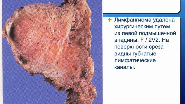 МЕЗЕНХИМАЛЬНЫЕ ОПУХОЛИ.ОПУХОЛИ МЕЛАНИНООБРАЗУЮЩЕЙ И НЕРВНОЙ ТКАНЕЙ.
