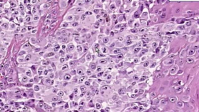Histopathology Skin --Malignant Melanom