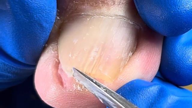 Pedicure Tutorial  Huge Ingrown Nail Trimming Full Process!【Xue Yidao Pedicure】