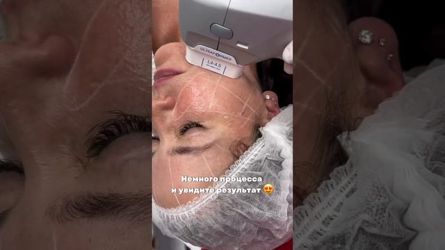 Процедура SMAS-lifting Ultraformer ?? смотреть онлайн