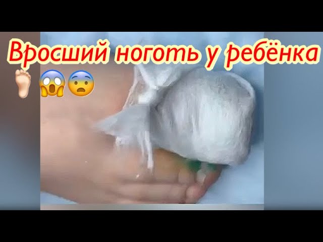 Вросший ноготь у ребёнка???? смотреть онлайн
