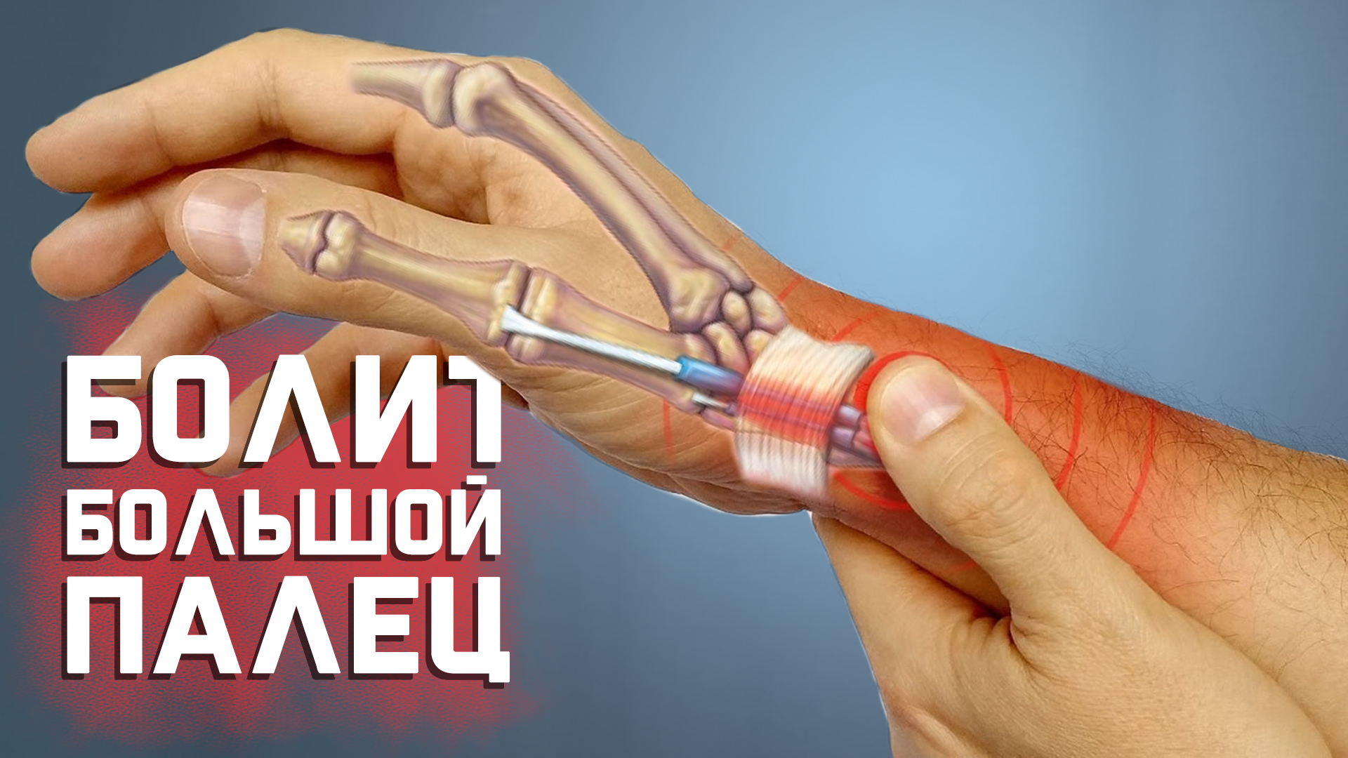 Болит большой палец при сгибании. Болезнь Де Кервена смотреть онлайн