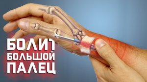 Болит большой палец при сгибании. Болезнь Де Кервена