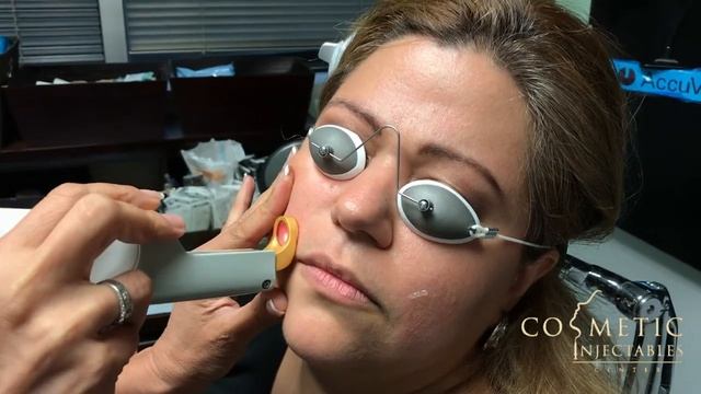 Cutera Laser Genesis смотреть онлайн