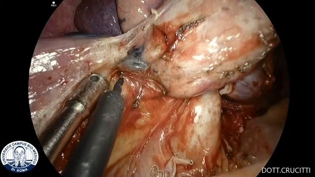 UNIPORTAL VATS: SUPERIOR BILOBECTOMY WITH MEDIASTINAL LYMPHNODES DISSECTION смотреть онлайн
