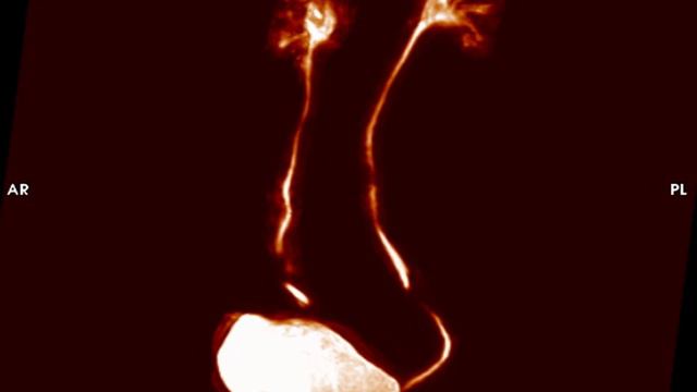 Non contrast enhanced MR Urography at 3 Tesla смотреть онлайн