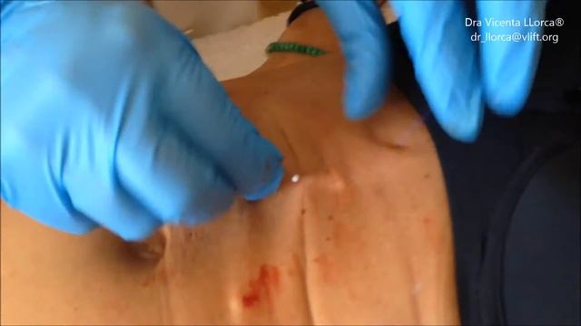 Técnica V Lift Pro - Abdomen (Dr. Vicenta Llorca) смотреть онлайн