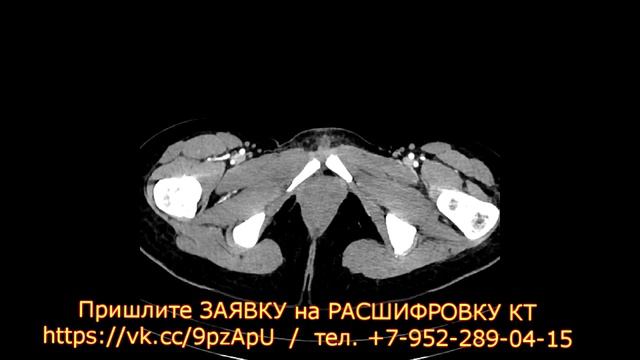 СИНДРОМ верхней брыжеечной артерии на РАСШИФРОВКЕ КТ брюшной полости. Синдром Уилки. смотреть онлайн