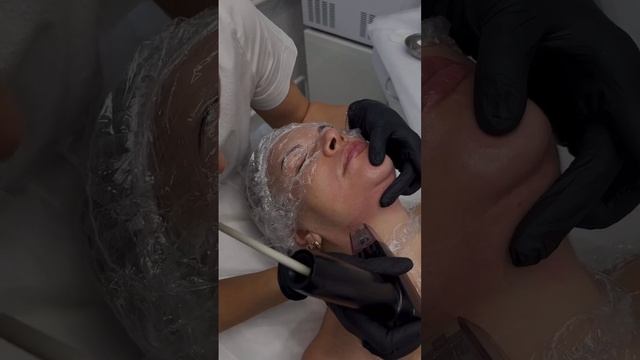 Фракционный RF-лифтинг с микроиглами. смотреть онлайн