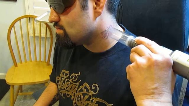 laser tatto removal смотреть онлайн