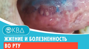 ? Жжение и болезненность во рту. Клинический случай №318