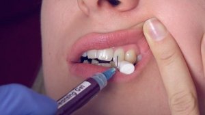 Установка скайса на зуб из набора TeethGemsBox (обучающее видео)