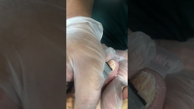 Paronychia with super severe onychomycosis【Foot Scalpel】 смотреть онлайн