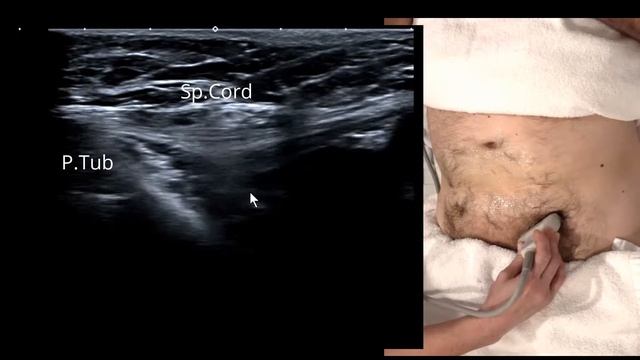 Femoral Hernia + Inguinal, sonographic live scan for direct vs indirect (reducible containing bowel смотреть онлайн