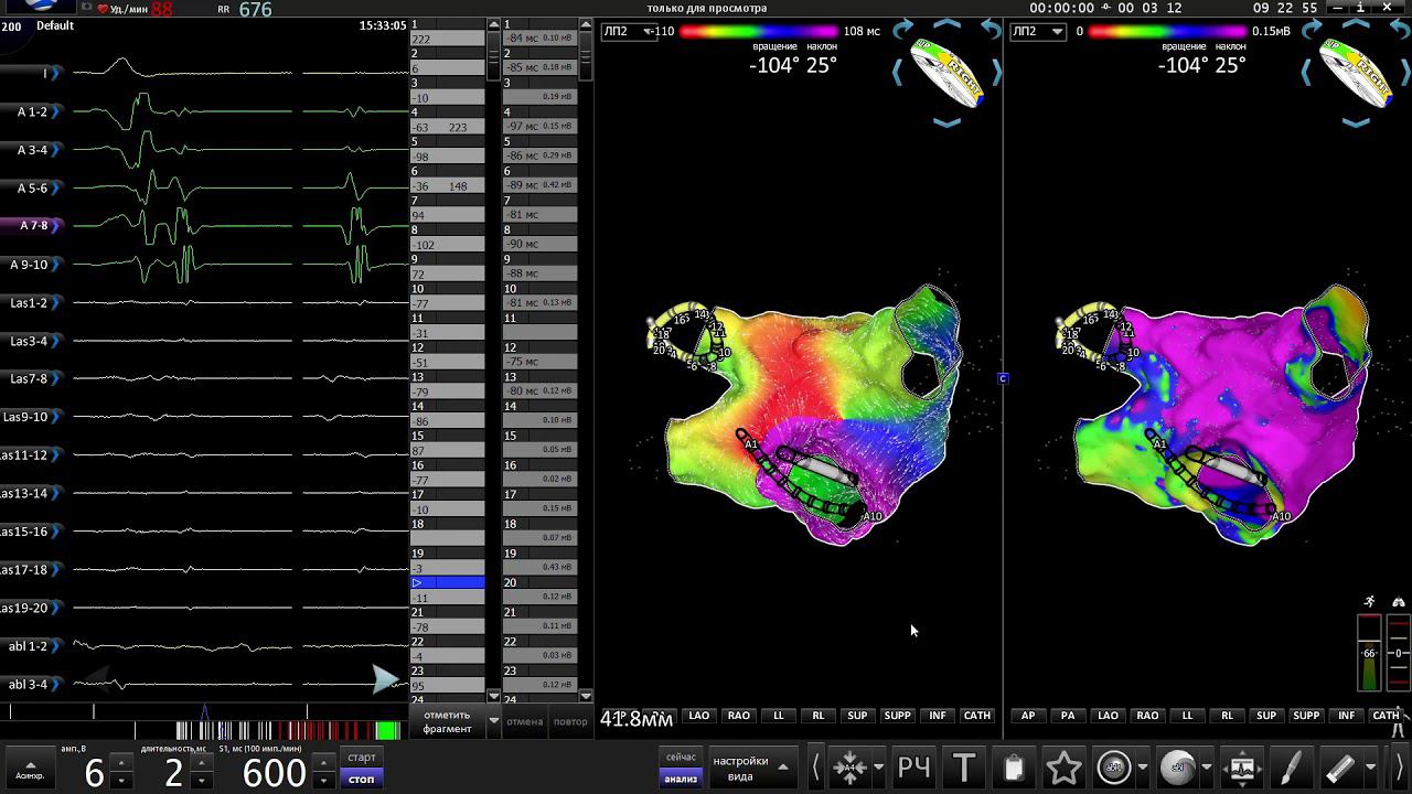 Flow map of left and right flutters смотреть онлайн