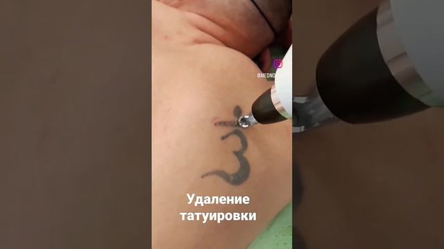 лазерное удаление татуировок - эффективный способ выведения пигмента с кожи смотреть онлайн