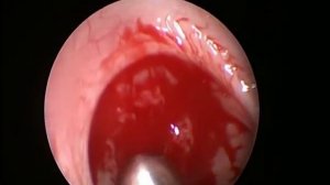 Удаление аденоидов у детей.Эндоскопический метод