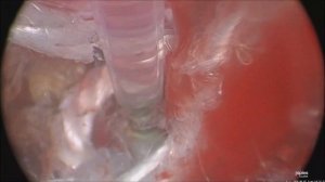 Удаление внутриматочных лигатур диодным лазером Лахта Милон