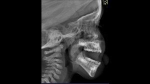 Укладка головы при рентгенографии носоглотки