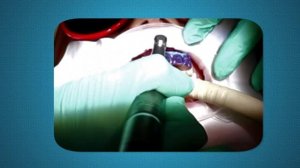 Микроабразия эмали: избавляемся от флюорозных пятен навсегда