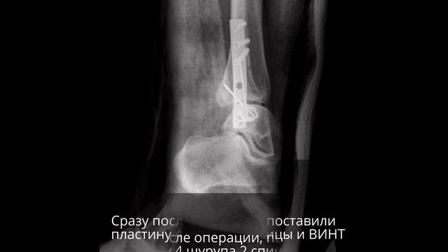 Закрытый перелом лодыжки со смещением моя история 5 часть снимки перелома лодыжки со смещением смотреть онлайн