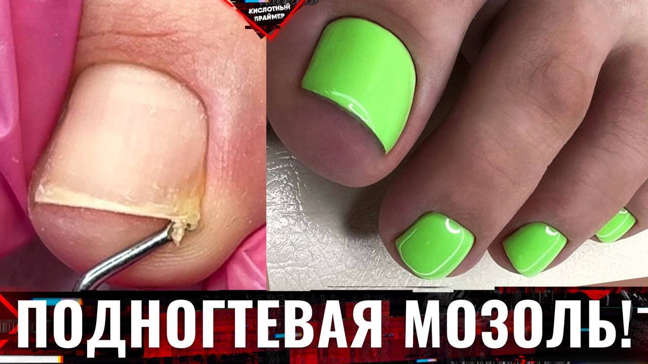 ?УСТАЛА МУЧАТЬСЯ! У клиентки СНОВА ПОДНОГТЕВАЯ МОЗОЛЬ!? Педикюр лето 2023? смотреть онлайн
